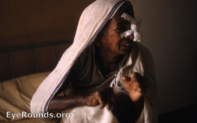 Post-op Leprosy patient