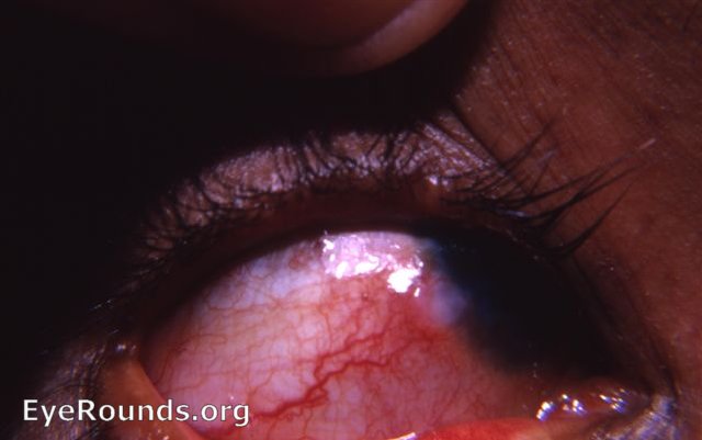 phlyctenular keratoconjunctivitis