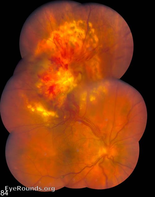 von Hippel Lindau (VHL) - retinal hemangioblastoma