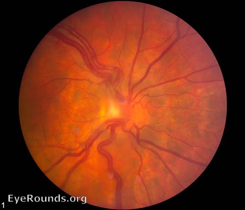 von Hippel Lindau (VHL) - retinal hemangioblastoma