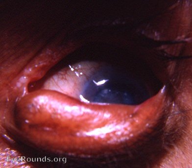 etropion OU with epidermalization, sebaceous cyst of upper lid OD, and temporal Bitot's spot OS
