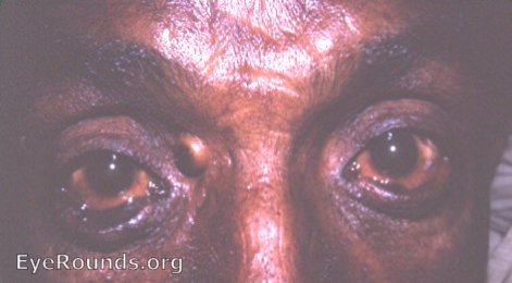 etropion OU with epidermalization, sebaceous cyst of upper lid OD, and temporal Bitot's spot OS
