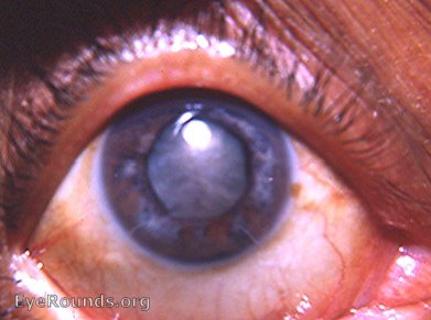 mature corticonuclear cataract with patchy heterochromia iridis OD