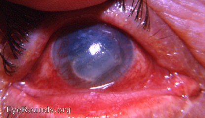 Disciform keratitis (HSV)-active with neovascularization