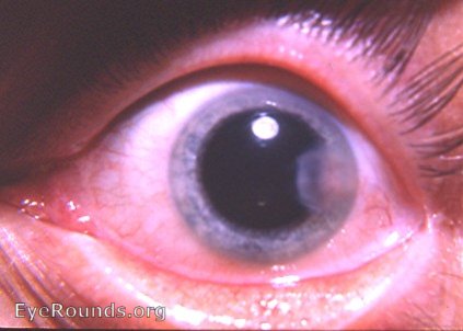 disciform keratitis due to herpes simplex virus - neovascularized