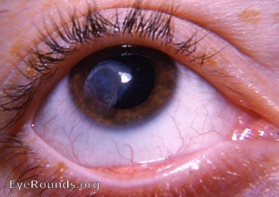 Disciform keratitis due to herpes simplex virus - active stage with neovascularization of cornea.