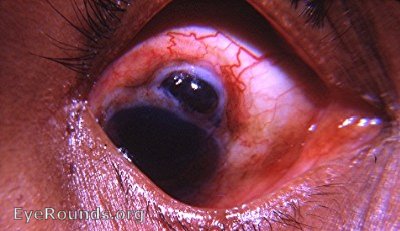 postop prolapse of iris