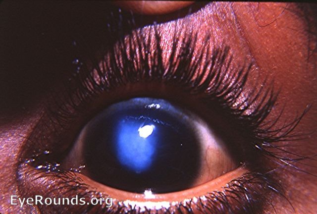 Primary congenital glaucoma ( hydropthalmos) with central corneal leucoma with striae/folds  ( Haab's Striae) in Descemet's membrane