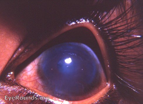 hydrophthalmos OU with leukomatous cornea OS