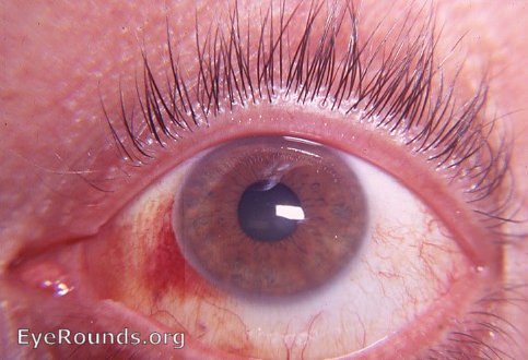 hyposphagma ( subconjunctival hemorrhage ) after retching