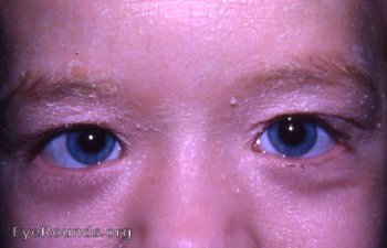 ichthyosis