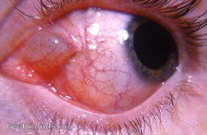 conjunctival cyst: epithelial inclusion cyst