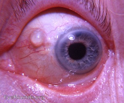 conjunctival cyst: epithelial inclusion cyst