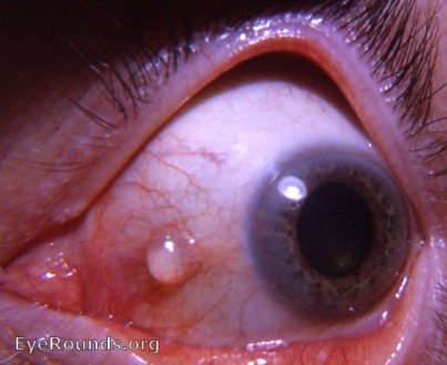 conjunctival cyst: epithelial inclusion cyst