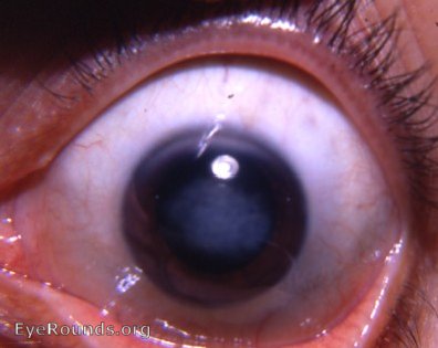 Interstitial keratitis due to congenital syphilis