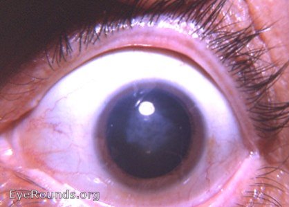 syphilis: congenital interstitial keratitis