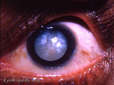the intumescent cataract