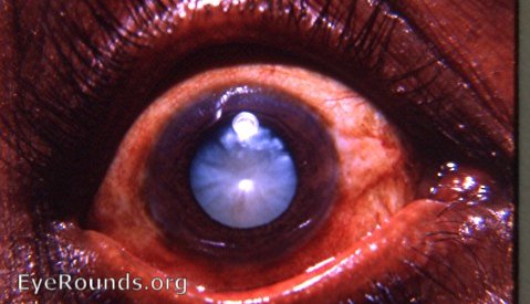 the intumescent cataract