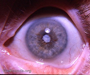 Anterior segment changes following years of retinal detachment