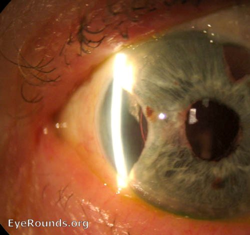 Patient with blunt trauma resulting in tear of the iris - 1