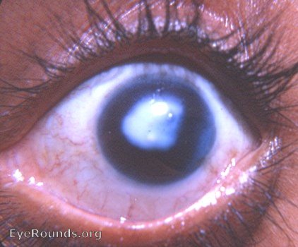 Corneal leukoma with iridodialysis