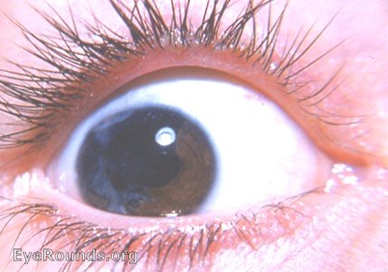 iris atrophy following traumatic hyphema