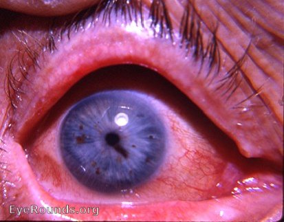 freckled iris with ? iris nevus