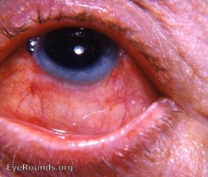 cataract: iris prolapse as a postop complication of recent cataract surgery.