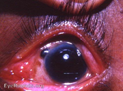 iris prolapse following intracapsular cataract surgery without sutures