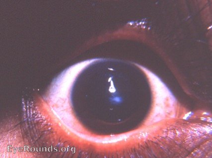cornea: keratoconus with apical scarring