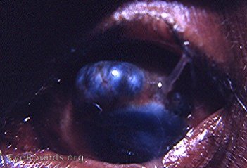 keratomalacia - an extreme stage with cornea and ciliary body staphylomata of an extreme degree