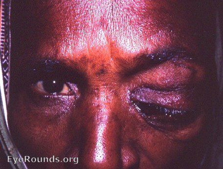 Lacrimal gland: tumor with medial displacement of eyeball