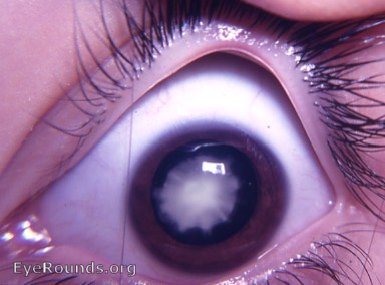 Lamellar/Zonular cataract