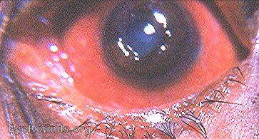 lens tamponade of corneal defect
