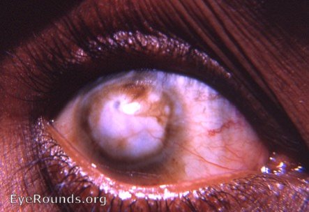 cornea: leukomatous scar due to hypopyon ulcer with perforation.