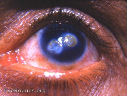 cornea: macular corneal scar - a residual of a noe inactive keratitis