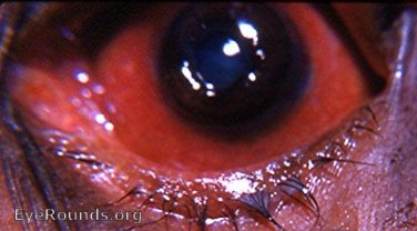 lens tamponade of corneal defect