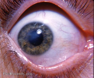 cornea: macular corneal scar - a residual of a noe inactive keratitis