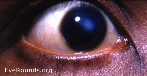 cornea: macular corneal scar - a residual of a noe inactive keratitis