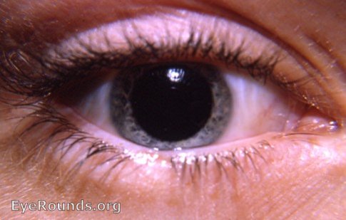 Varicella/ chickenpox: loss of lashes ( madarosis ) lower lid