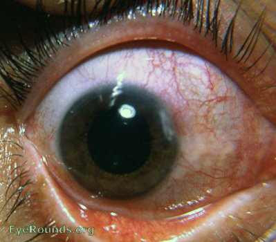 marginal keratitis with rosacea