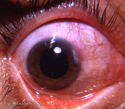 chronic blepharokeratoconjunctivitis associated with rosacea compounded by alcoholism