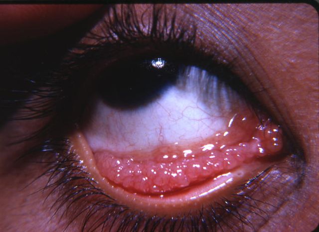 florid follicular formation in acute trachoma