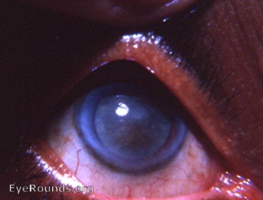 mature corticonuclear cataract with a cataracta nigra component
