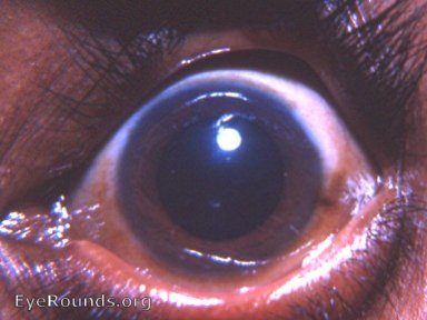 megalocornea