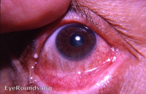 meibomian gland cyst