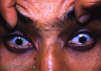 microcornea in bpth eyes