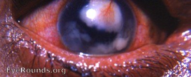 mycotic abscess of cornea with hypopyon