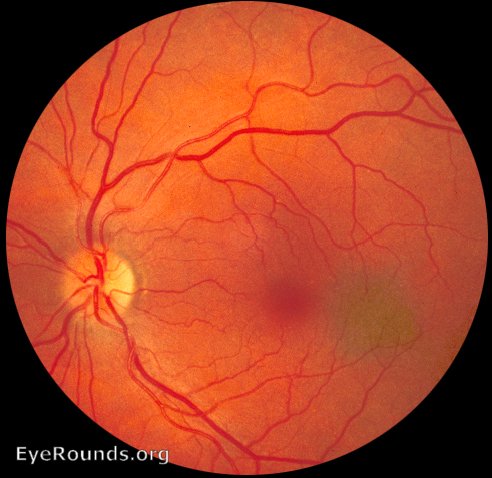 Atlas Entry - Choroidal Nevus