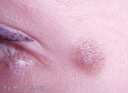 nevus: dermal nevus with hair